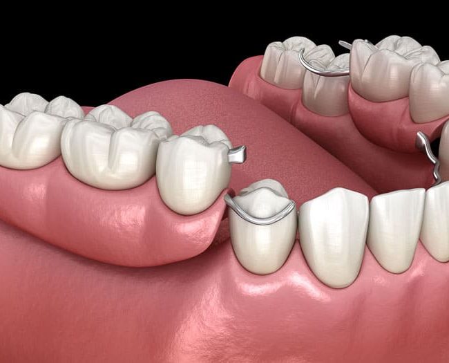 partial-dentures-16
