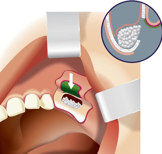 sinus-lifting-and-bone-grafting
